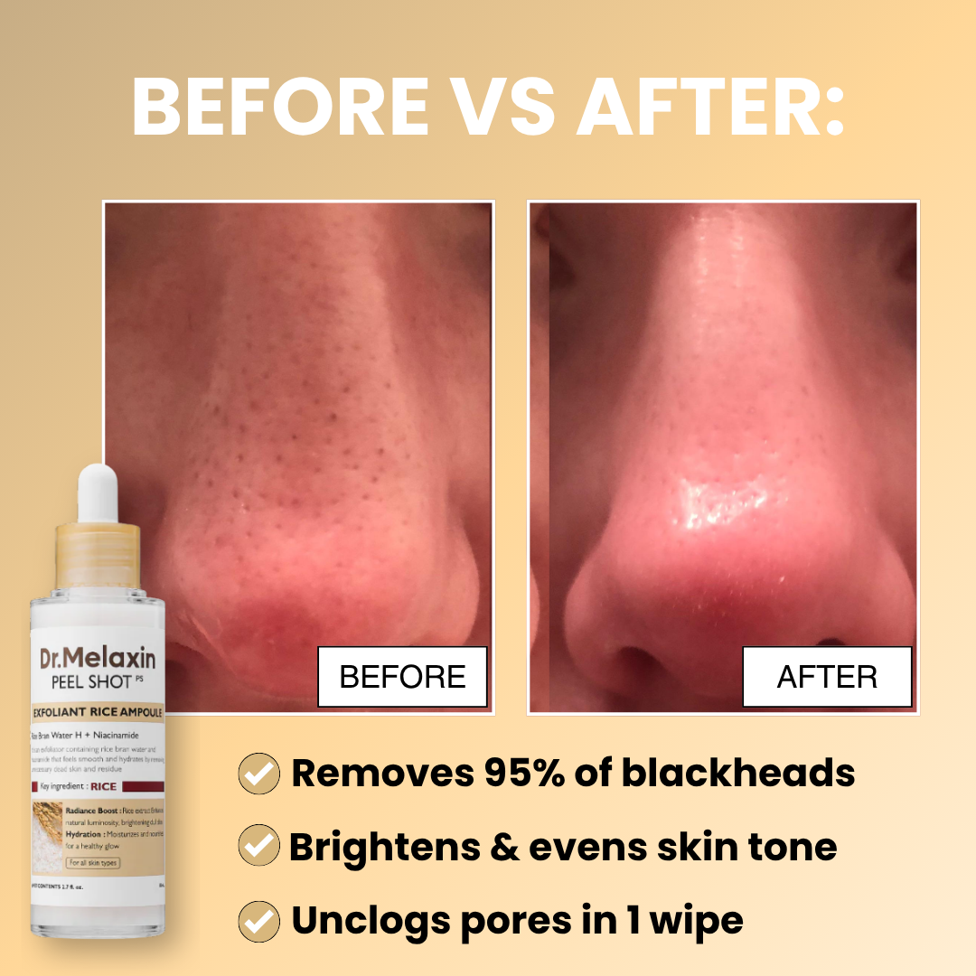 Peel Shot Blackhead Remover