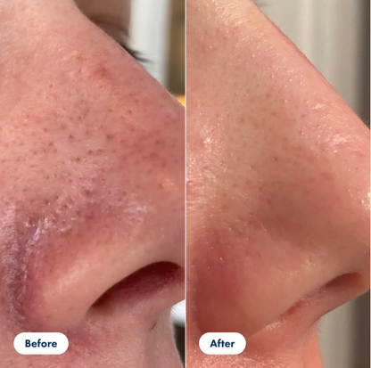 Viral Peel Shot